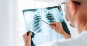 Aumento de casos de tuberculosis en Salta: en 2024 se registraron 967 diagnósticos