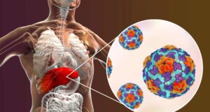 Alerta en el norte provincial por brote de Hepatitis A